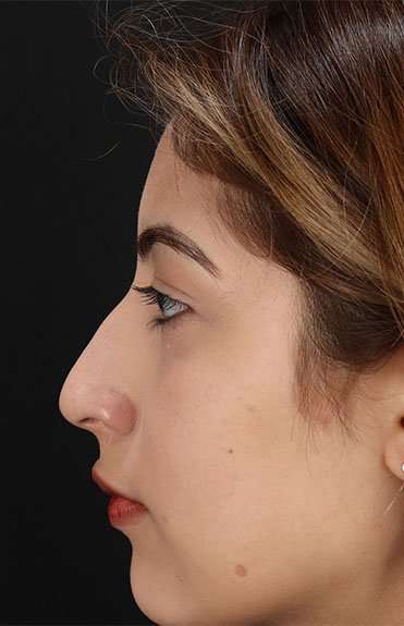 Liquid Rhinoplasty Before & After Patient #2254