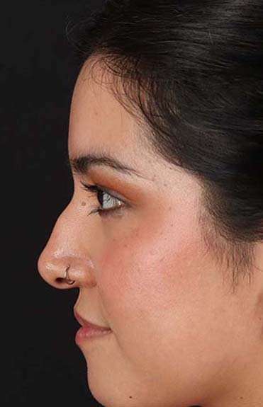 Liquid Rhinoplasty Before & After Patient #2265