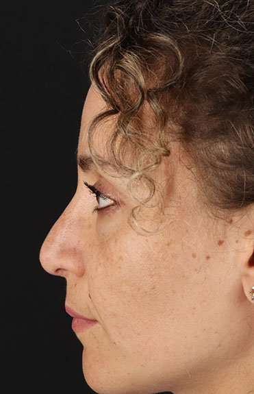 Liquid Rhinoplasty Before & After Patient #2276
