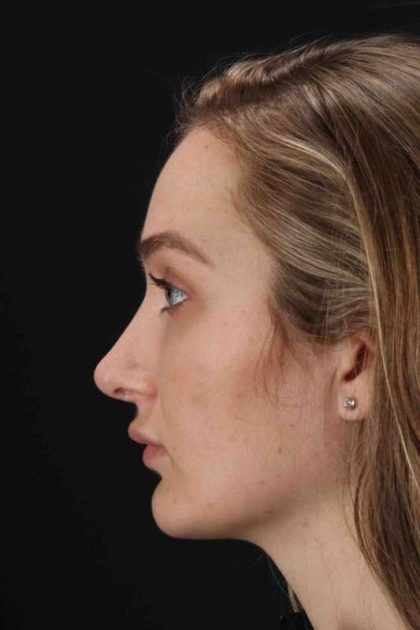 Browlift Before & After Patient #1297