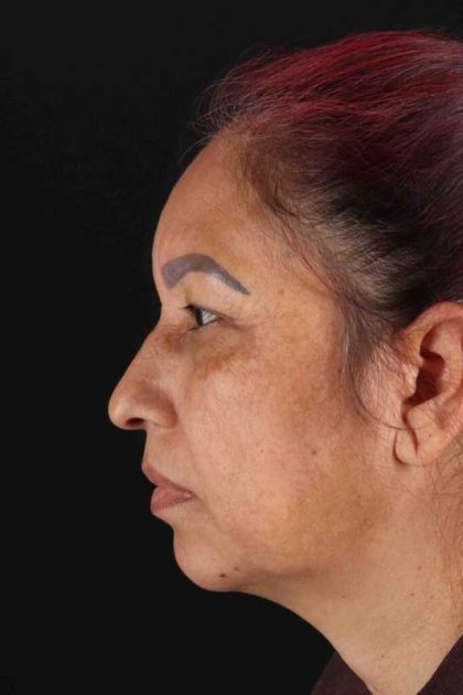 Lower Blepharoplasty Before & After Patient #2321