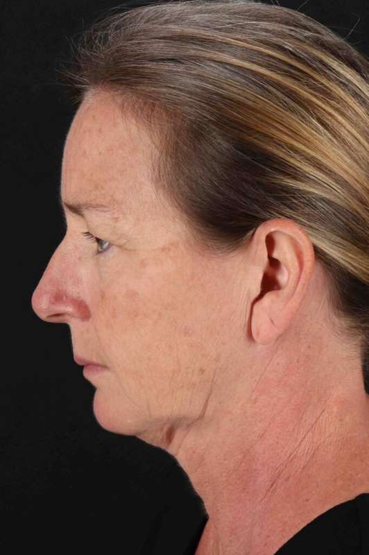 Lower Blepharoplasty Before & After Patient #2332