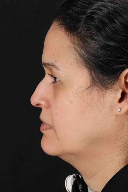 Lower Blepharoplasty Before & After Patient #2365