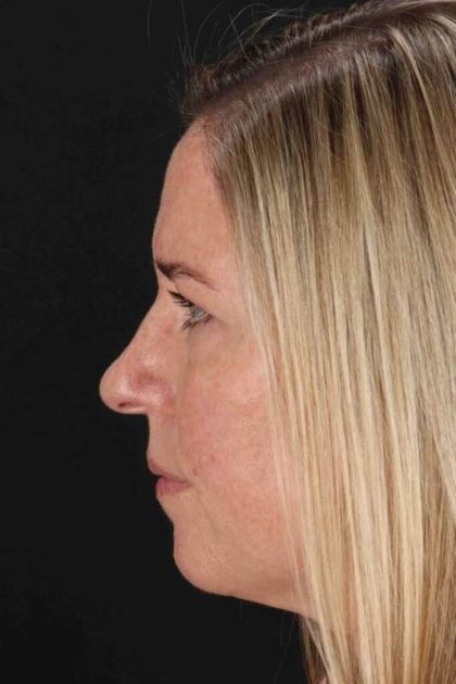 Lower Blepharoplasty Before & After Patient #2376