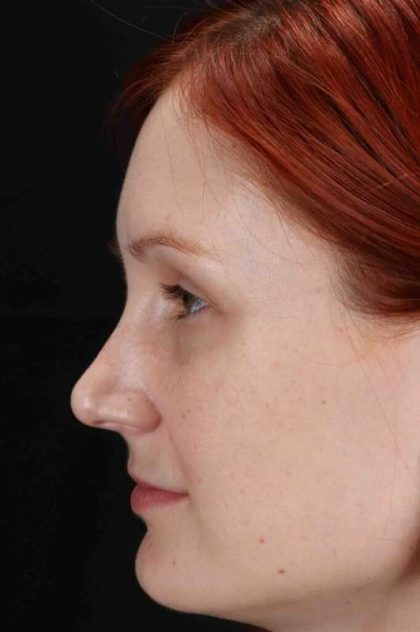 Lower Blepharoplasty Before & After Patient #2409