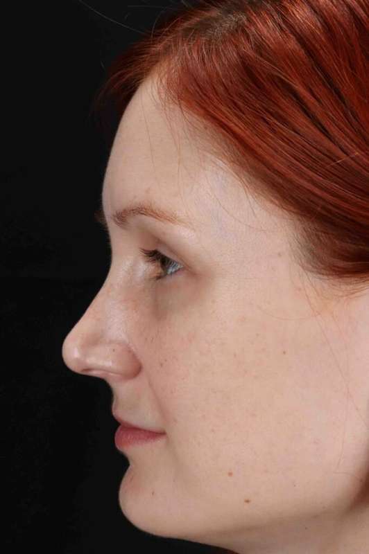 Lower Blepharoplasty Before & After Patient #2409