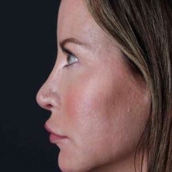 Browlift Before & After Patient #1308