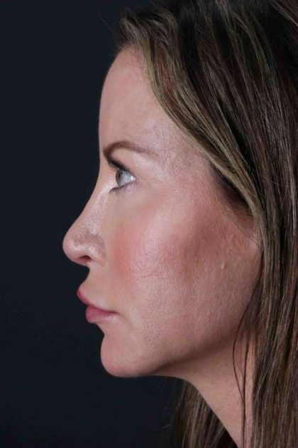 Browlift Before & After Patient #1308