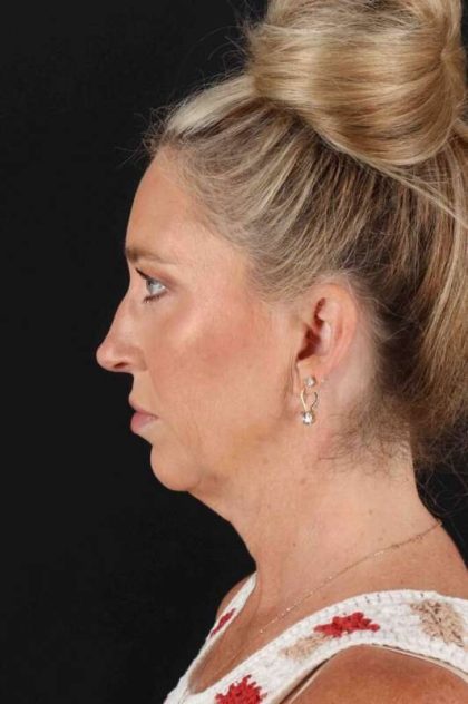 Neck Lift Before & After Patient #2441