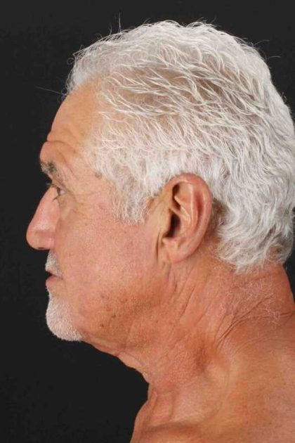 Neck Lift Before & After Patient #2483