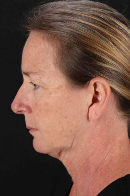 Neck Lift Before & After Patient #2494