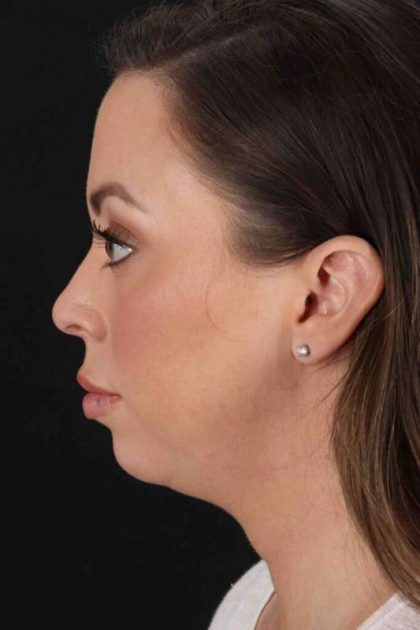 Neck Lift Before & After Patient #2505