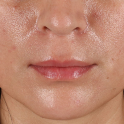 Lip Lift Before & After Patient #2166