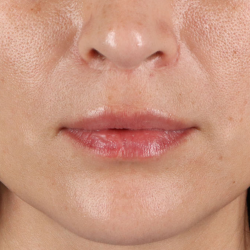 Lip Lift Before & After Patient #2166