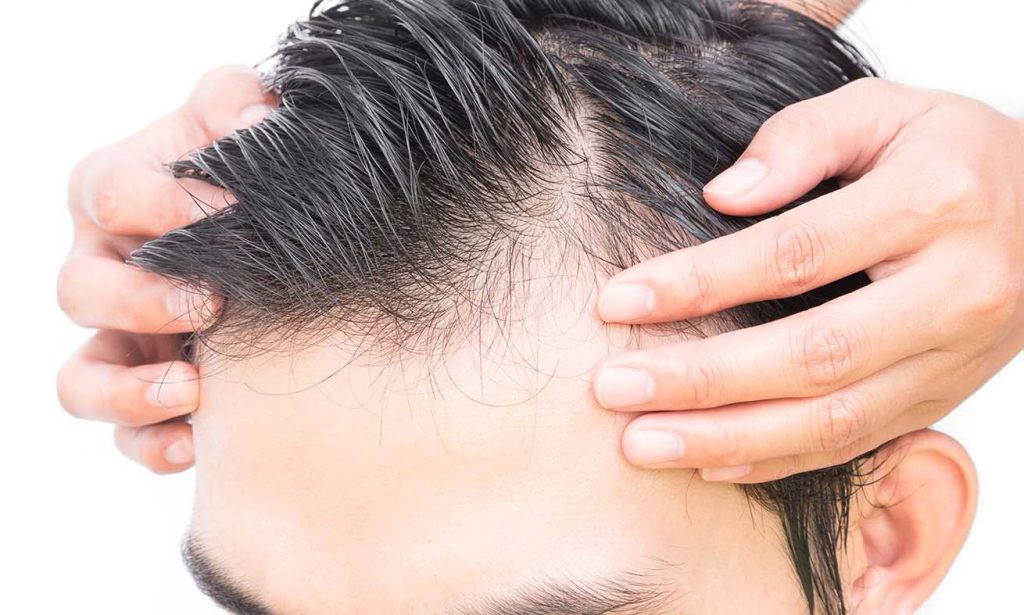 Hairline Advancement / Hairline Lowering