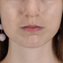 Buccal Fat Pad Before & After Patient #4687