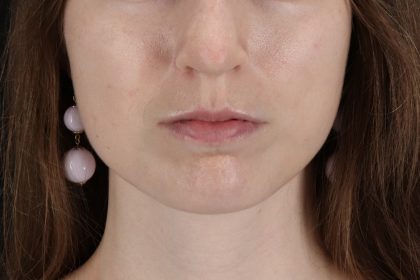 Buccal Fat Pad Before & After Patient #4687