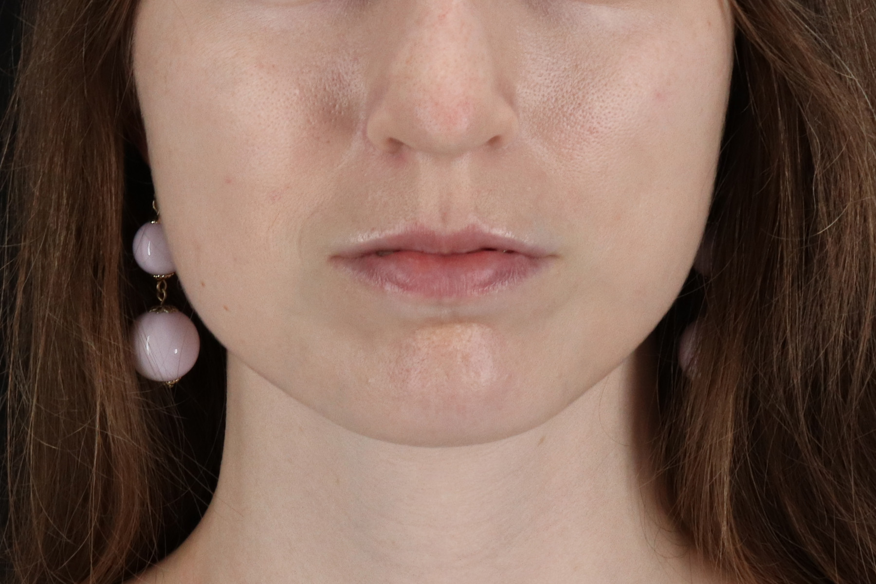 Buccal Fat Pad Before & After Patient #4687