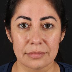 Buccal Fat Pad Before & After Patient #4666