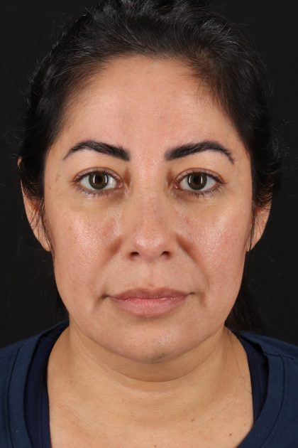 Buccal Fat Pad Before & After Patient #4666
