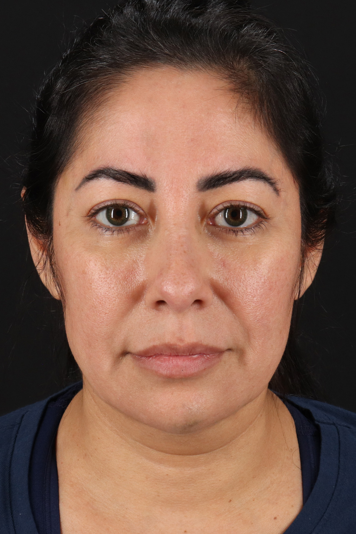 Buccal Fat Pad Before & After Patient #4666