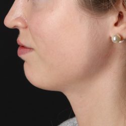 Buccal Fat Pad Before & After Patient #4687