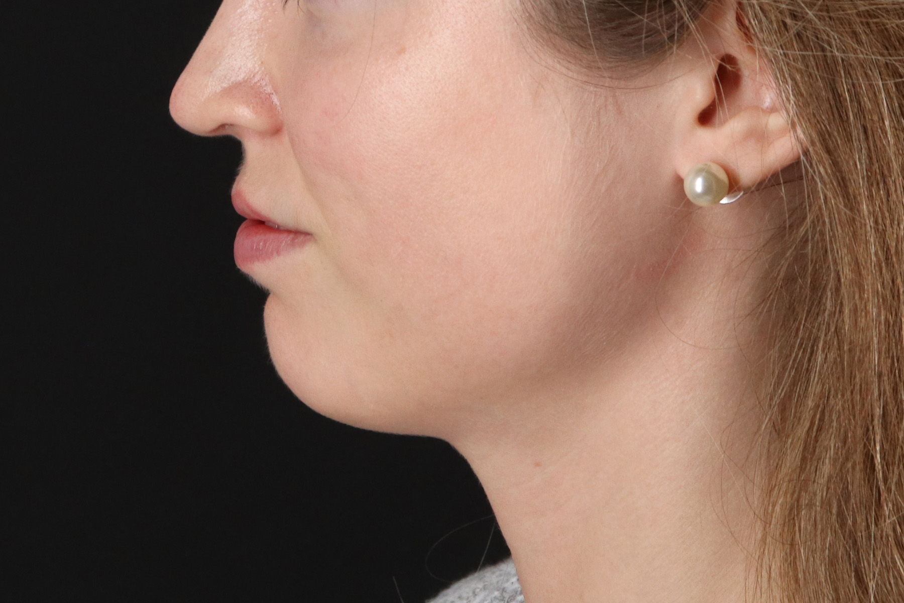 Buccal Fat Pad Before & After Patient #4687
