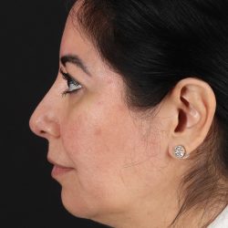 Buccal Fat Pad Before & After Patient #4666