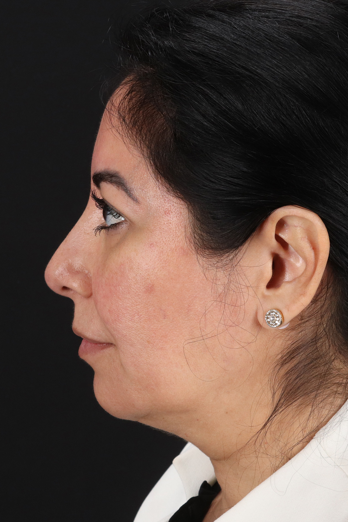 Buccal Fat Pad Before & After Patient #4666