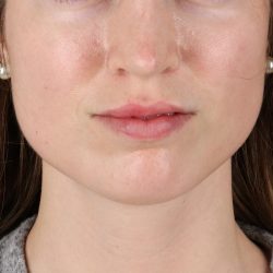Buccal Fat Pad Before & After Patient #4687