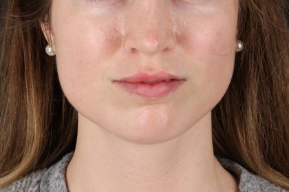 Buccal Fat Pad Before & After Patient #4687