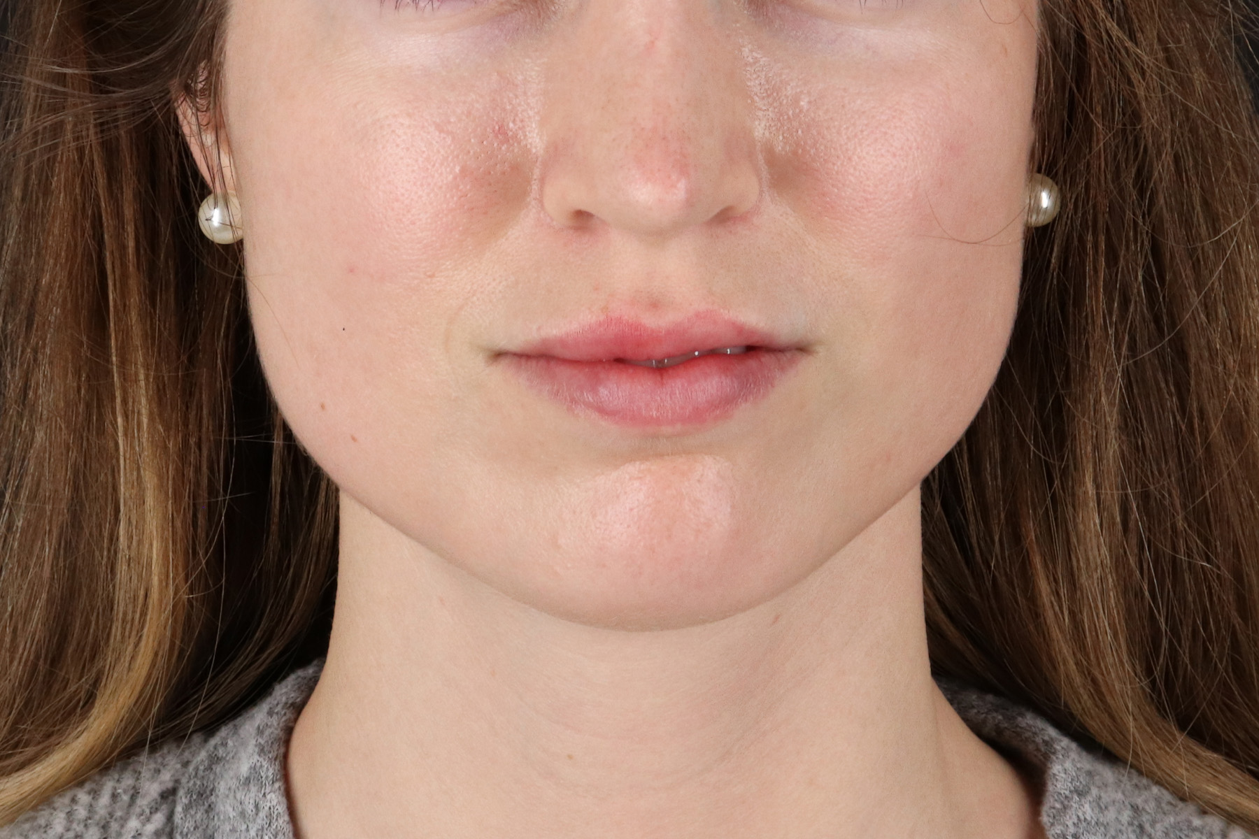 Buccal Fat Pad Before & After Patient #4687