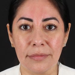 Buccal Fat Pad Before & After Patient #4666