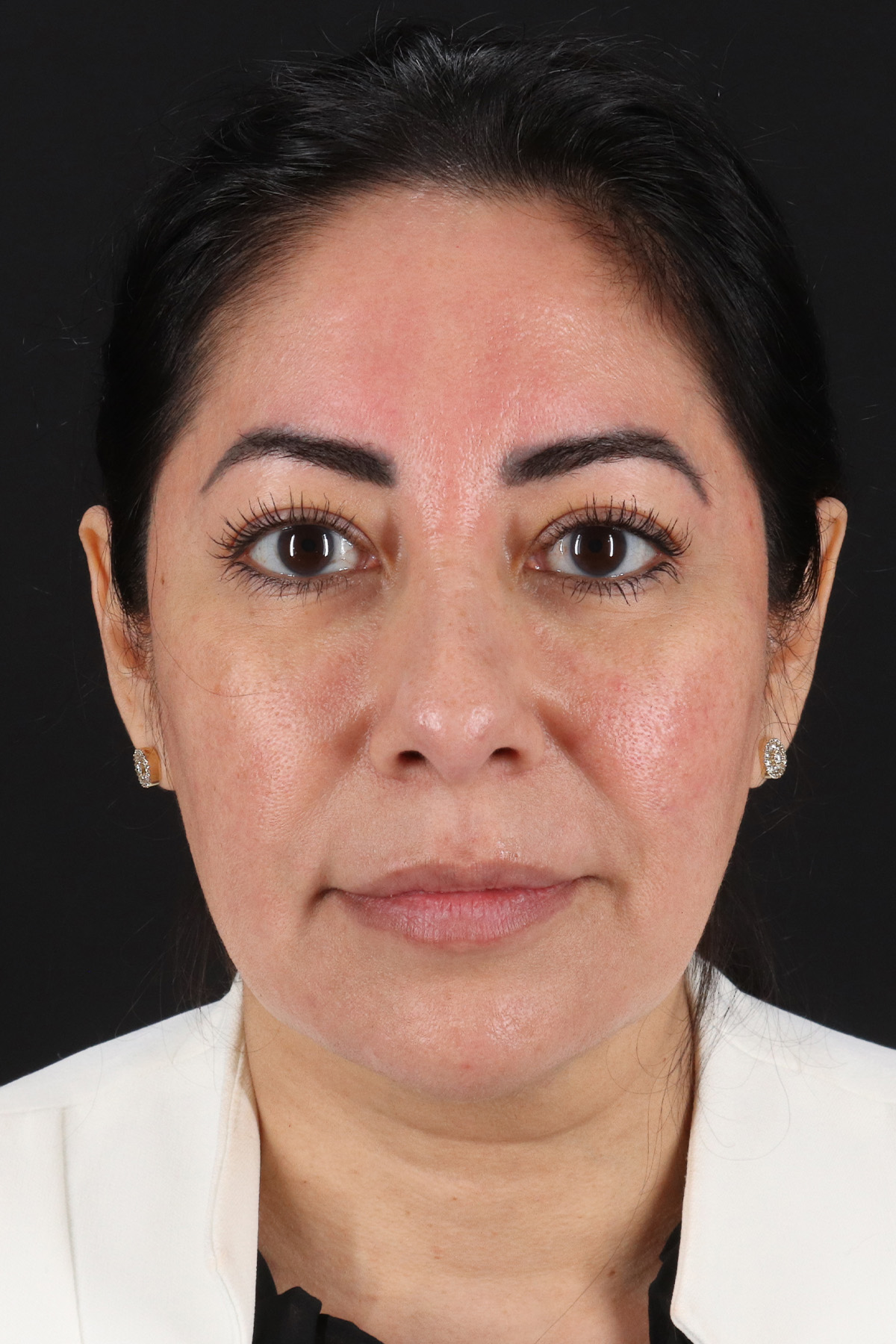Buccal Fat Pad Before & After Patient #4666