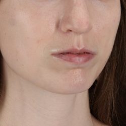 Buccal Fat Pad Before & After Patient #4687