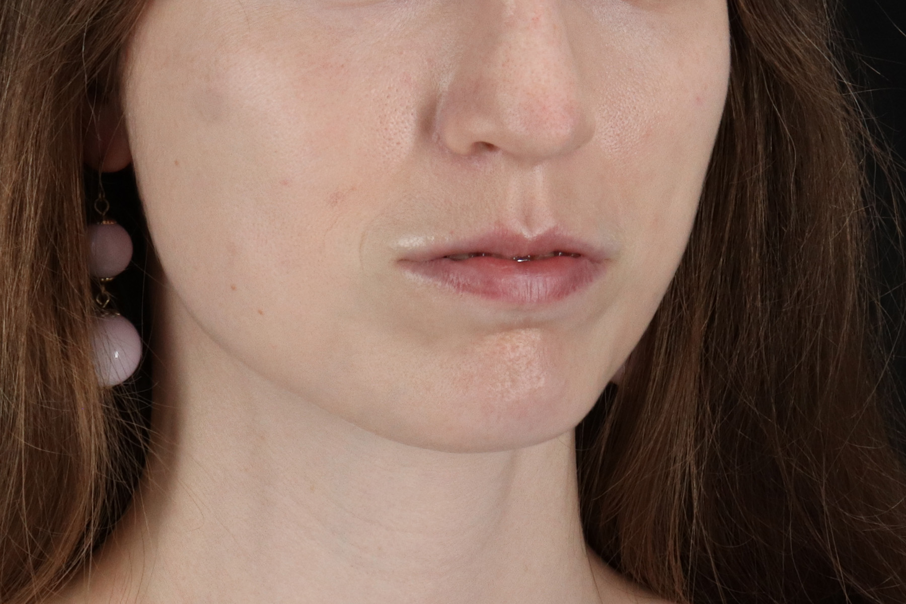 Buccal Fat Pad Before & After Patient #4687