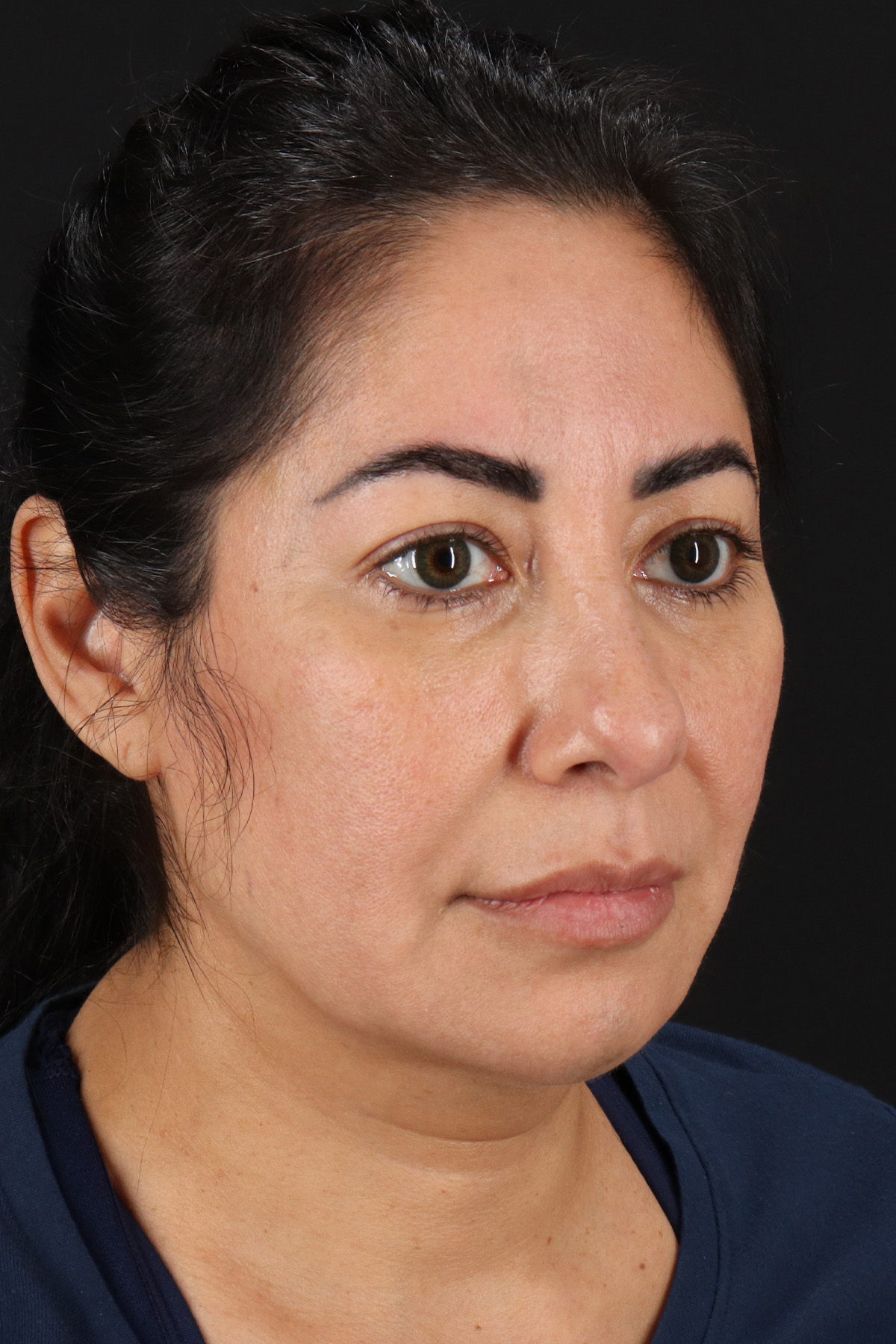 Buccal Fat Pad Before & After Patient #4666