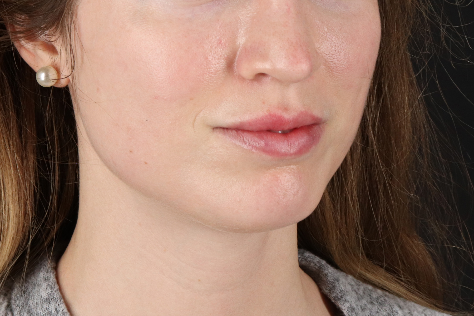 Buccal Fat Pad Before & After Patient #4687