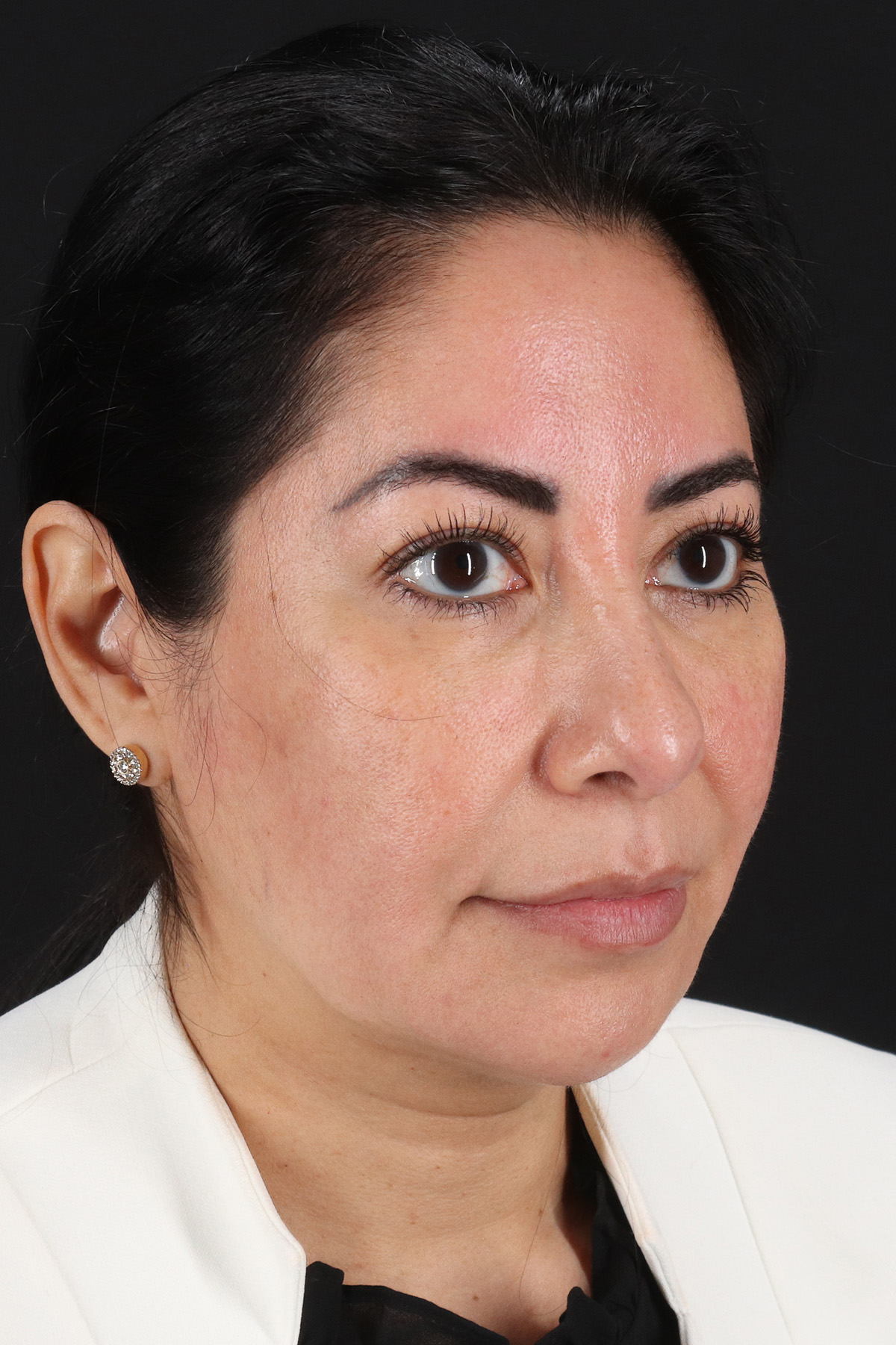 Buccal Fat Pad Before & After Patient #4666