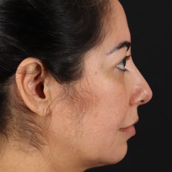 Buccal Fat Pad Before & After Patient #4666