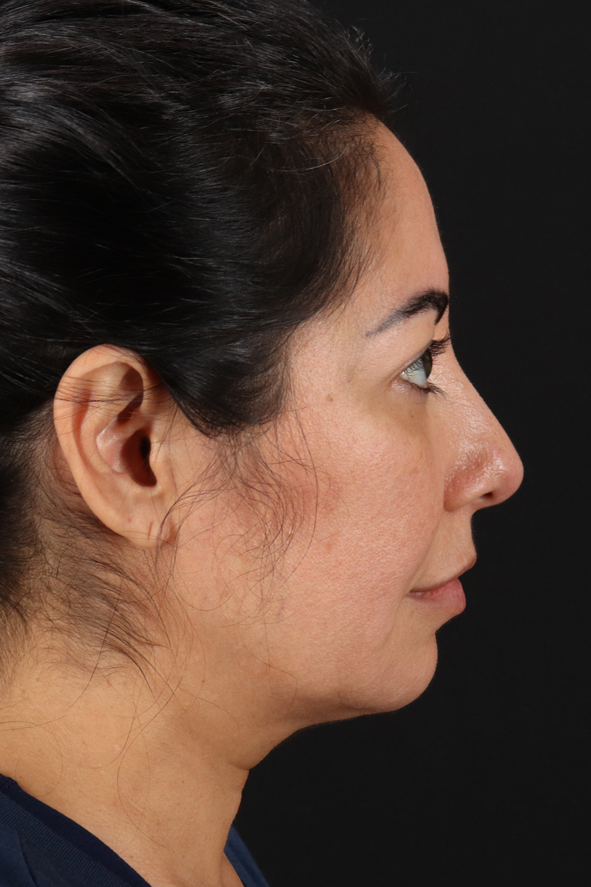 Buccal Fat Pad Before & After Patient #4666