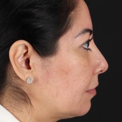 Buccal Fat Pad Before & After Patient #4666