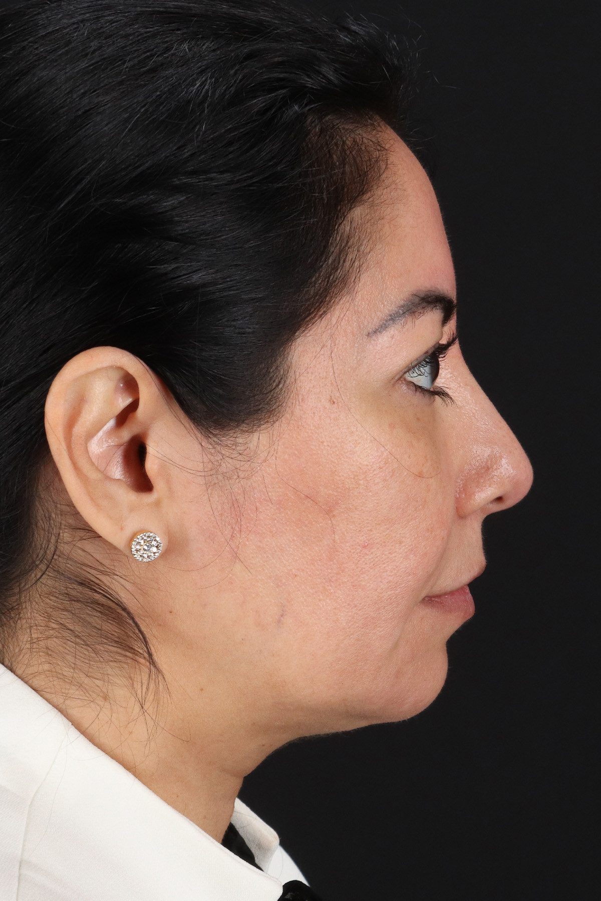 Buccal Fat Pad Before & After Patient #4666