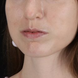 Buccal Fat Pad Before & After Patient #4687