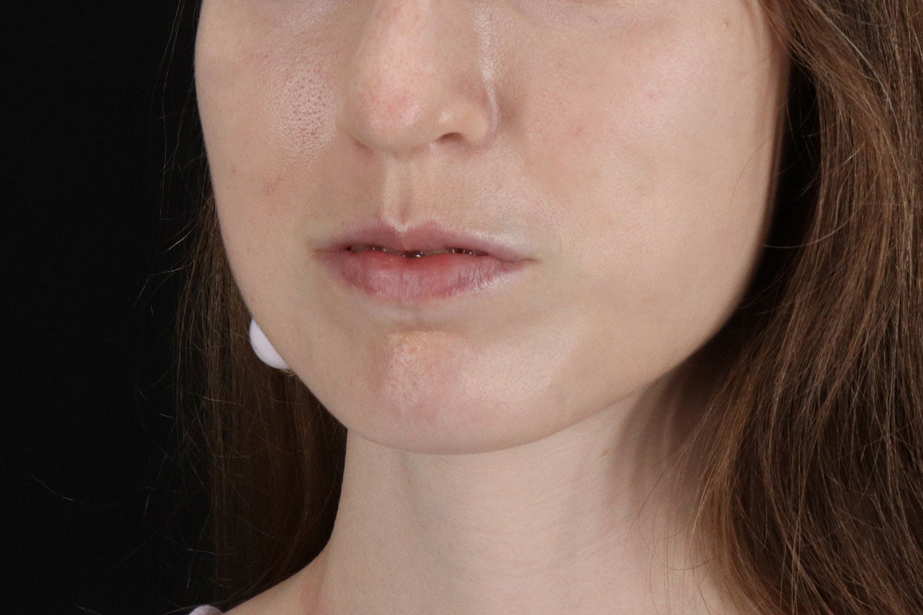 Buccal Fat Pad Before & After Patient #4687