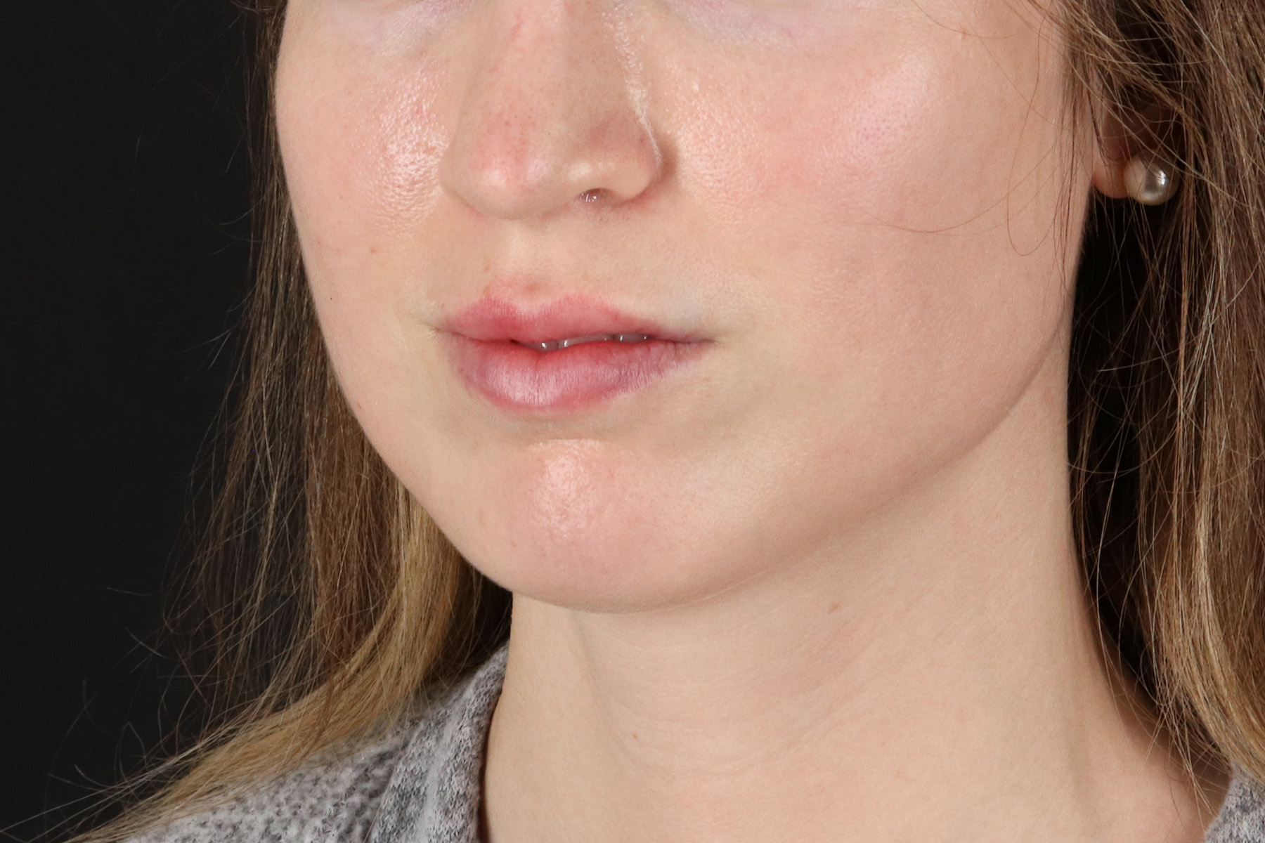 Buccal Fat Pad Before & After Patient #4687