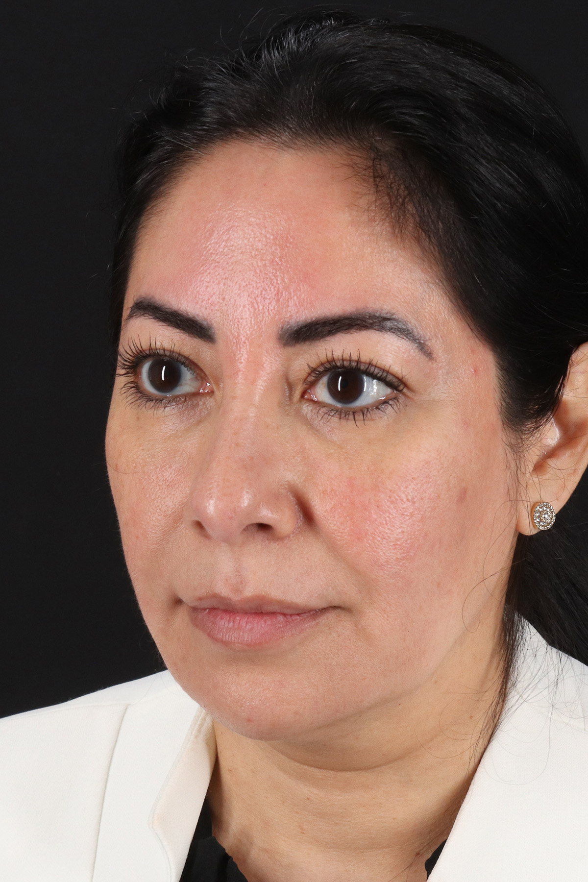 Buccal Fat Pad Before & After Patient #4666