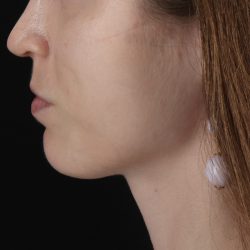 Buccal Fat Pad Before & After Patient #4687