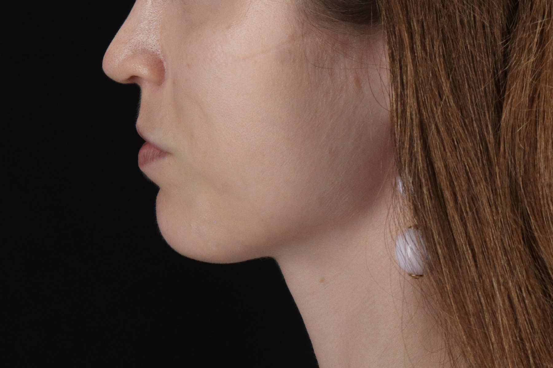 Buccal Fat Pad Before & After Patient #4687