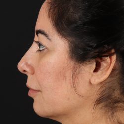 Buccal Fat Pad Before & After Patient #4666